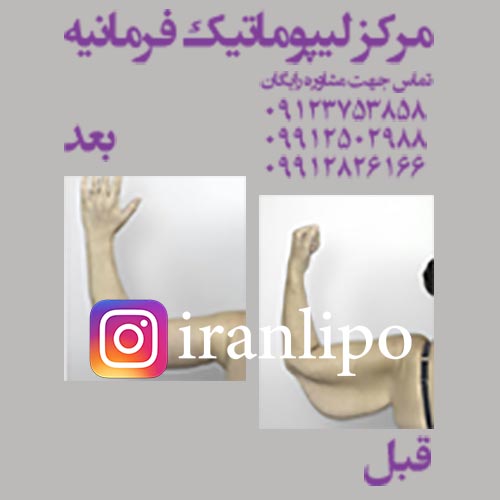 نمونه درمان لیپوماتیک بازو