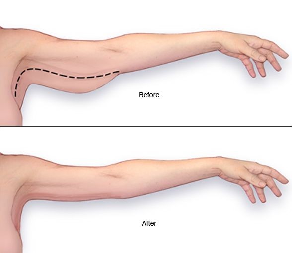 قبل و بعد لیپوماتیک بازو